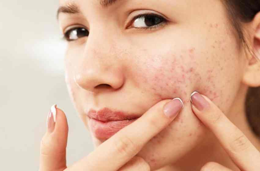 روشهای جلوگیری از جوش و آکنه